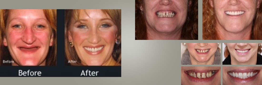 Upper Dentures Without Palate Ooltewah TN 37363